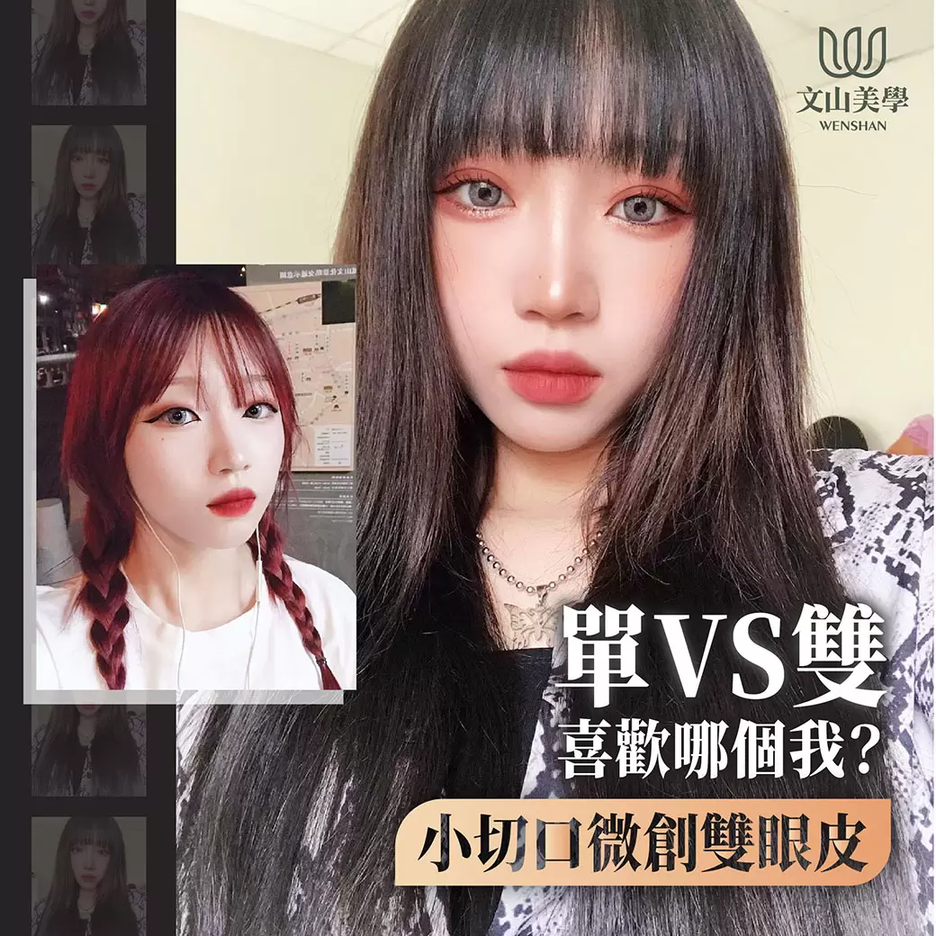 【達特楊美學診所-2店報報+高雄整形外科 小切口微創雙眼皮 院內案例】