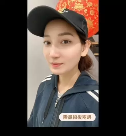 達特楊醫療聯盟 高雄隆鼻 院內案例