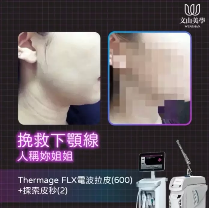 如果想挽救下顎線的你也害怕動刀【Thermage FLX電波拉皮(600)+探索皮秒(2)】