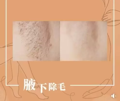 除毛為什麼要交給專業醫師操作？