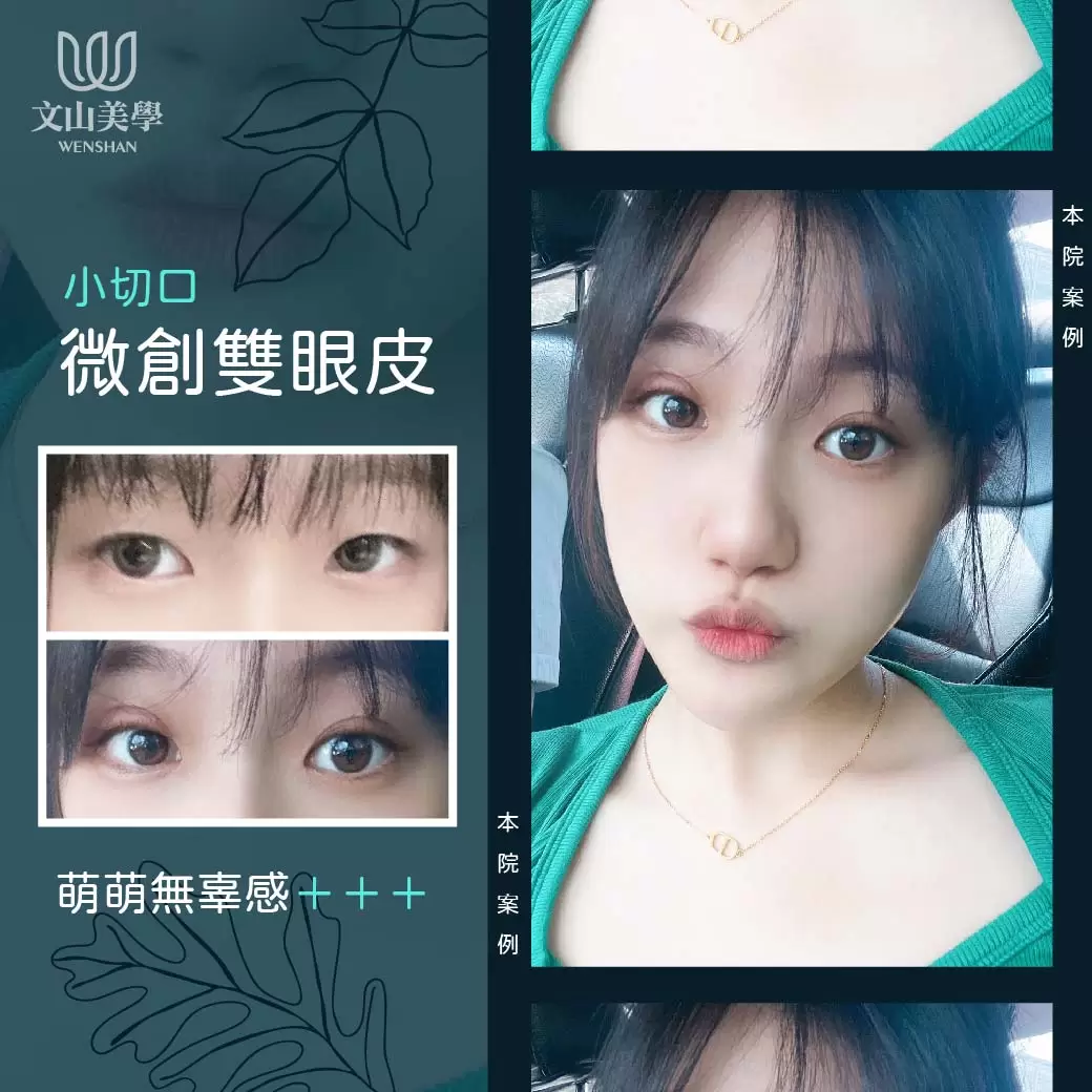 透過雙眼皮的調整來增加萌萌無辜感【小切口微創雙眼皮】
