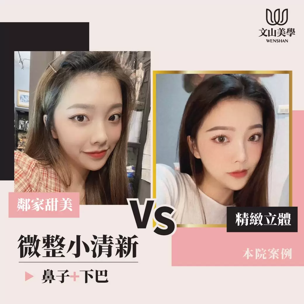 鄰家甜美 VS 精緻立體 | 本院案例『鼻子＋下巴』
