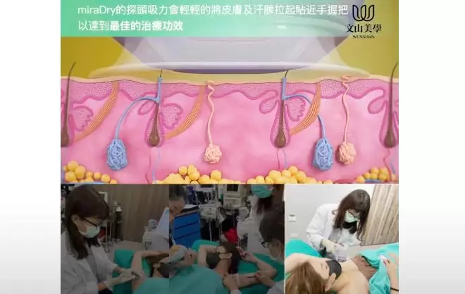 清新微波miraDry舒適過程分享