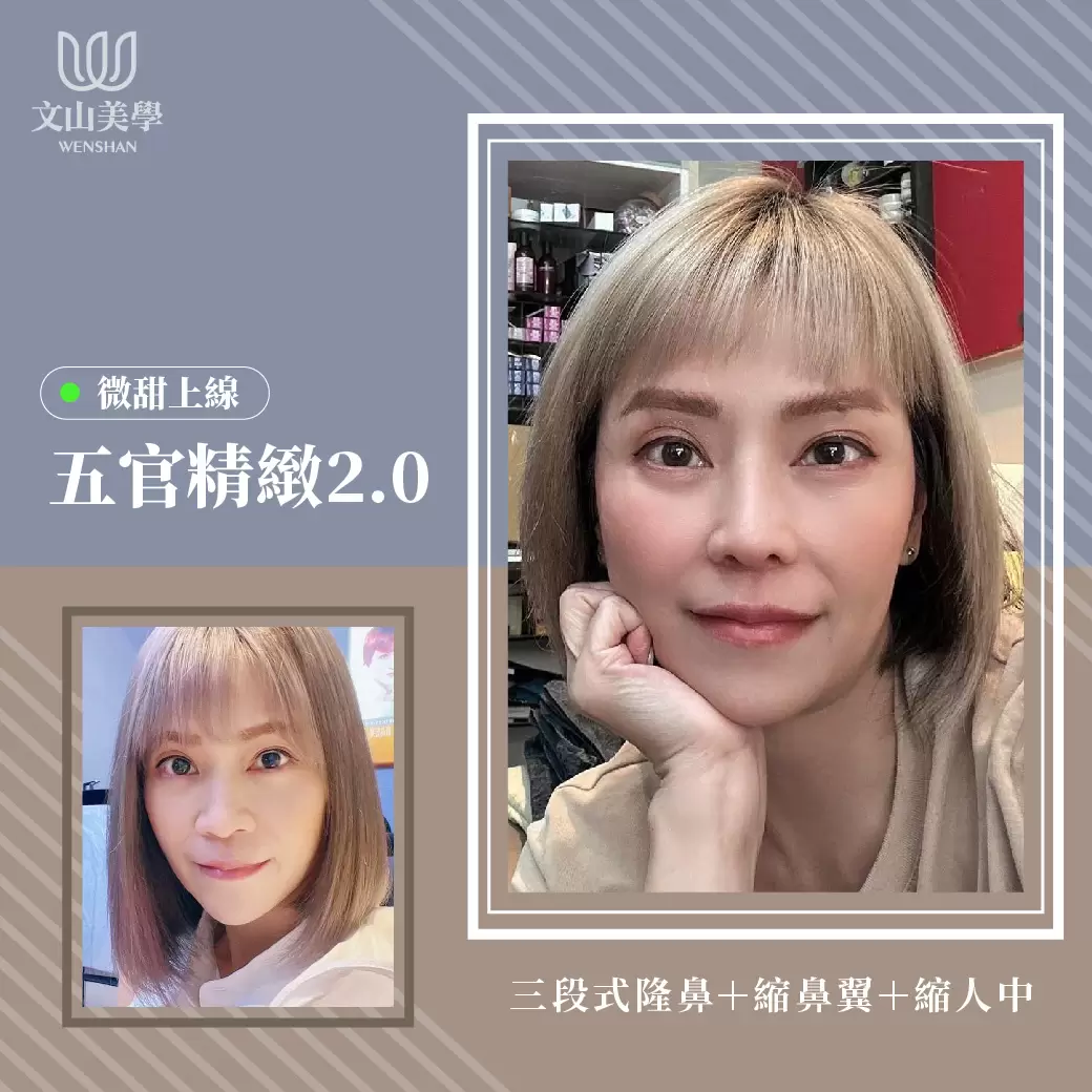 高雄整形外科【五官精緻微甜2.0上線】三段式隆鼻+縮鼻翼+縮人中