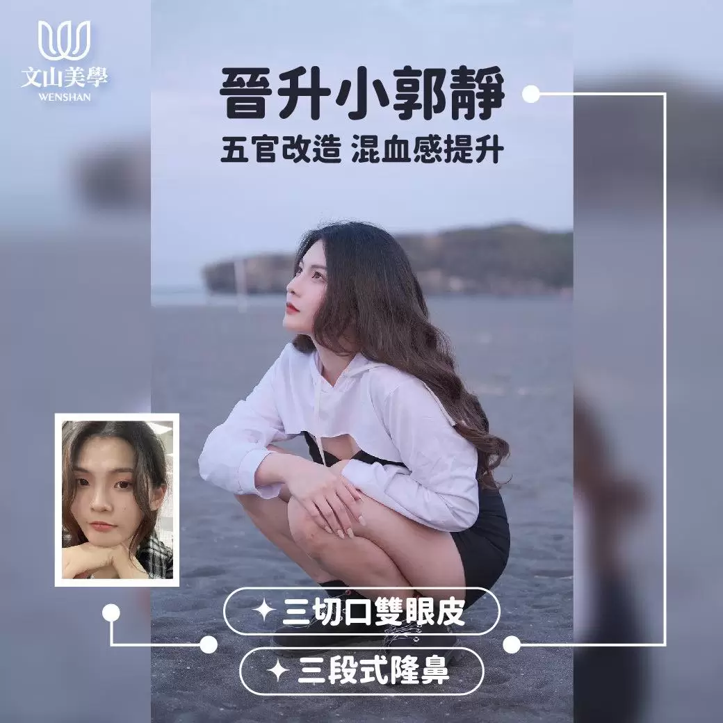 五官改造 混血感提升 高雄整形外科 三切口雙眼皮 三段式隆鼻