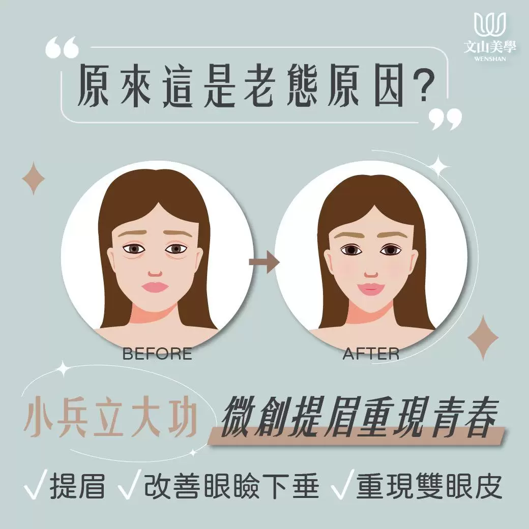 想改善眼瞼下垂 重現雙眼皮 微創提眉對抗眼周老化超有感！