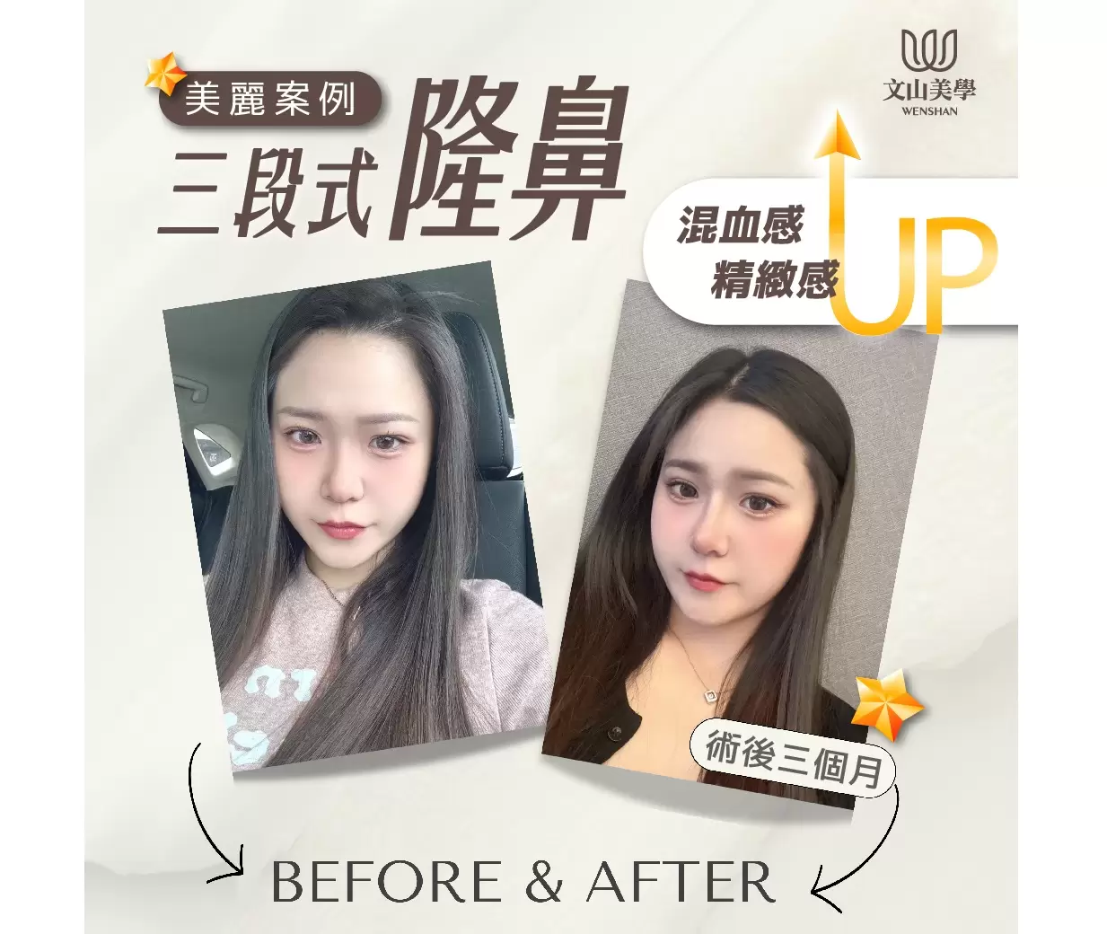 【三段式隆鼻 高雄整形外科】五官靈魂從鼻子開始