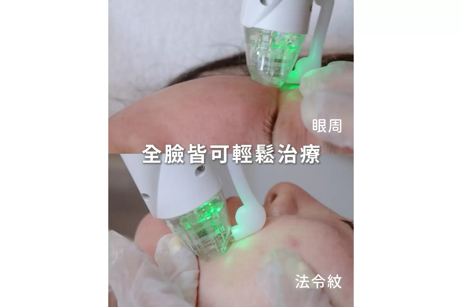 雷神微針電波 改善凹疤 縮小毛孔 撫平紋路 由內而外找回你的緊緻完美肌