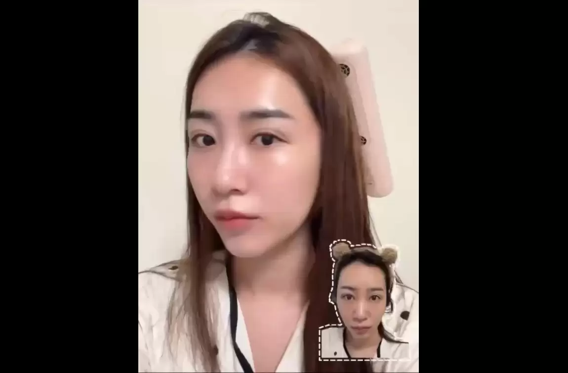 嚮往韓妞的光澤肌 對光敏感或不愛雷射 水光注射是絕佳選擇