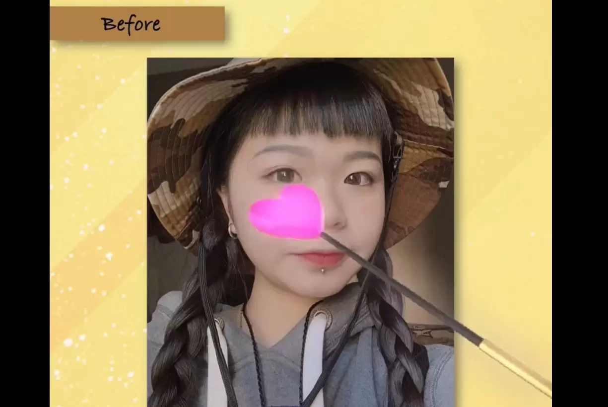 晉升甜美妞 掰掰蒜頭鼻 高雄整形外科 三段式隆鼻＋縮鼻翼 院內案例