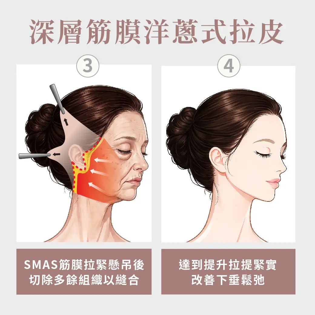 高雄整形外科張鈞凱醫師 中下臉拉皮│從側臉到下顎線條慢慢變得更清晰