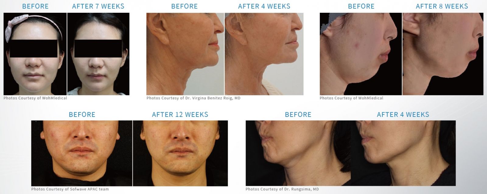 適合高雄索夫波療程的眉眼鬆弛無神，臉部皺紋、頸紋，下半臉輪廓線模糊，雙下巴、嘴邊肉明顯，皮膚觸感鬆垂。